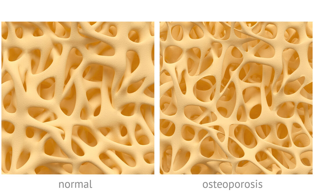 🦴 Natural Solutions for Bone Density and Joint Health